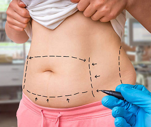 Tumescent Liposuction in Richmond Hill, GA