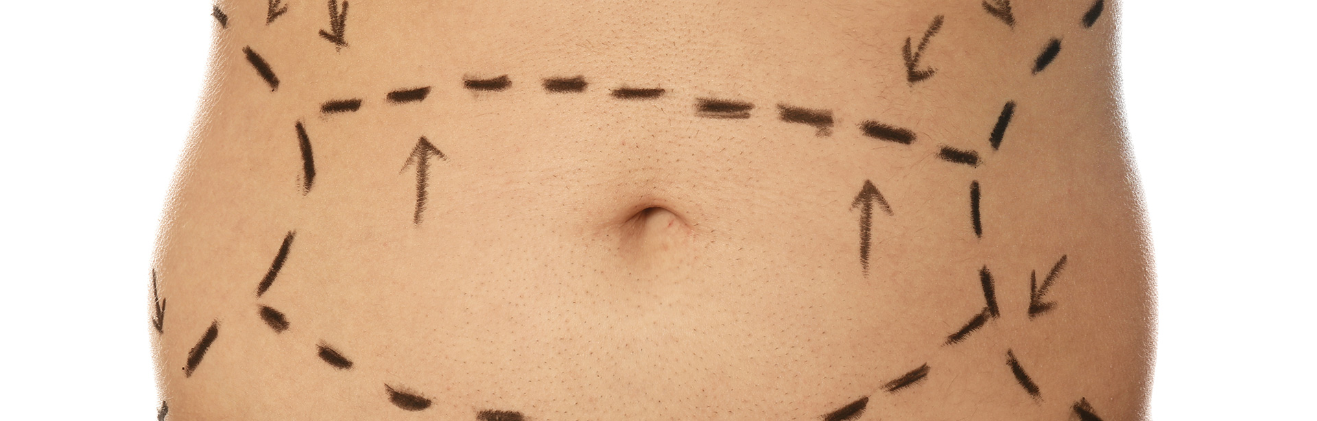 tummy tuck
